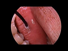 코골이 치료 다기능 프로브를 갖춘 고주파 플라즈마 발생기