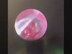 버터플라이 ENT 외과 도구 ENT 프로브