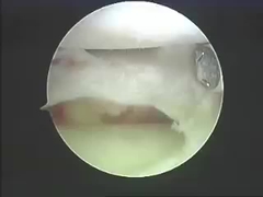 척추와 조인트를 위한 전기 수술 장치 어블레이션 시스템 융제 제품