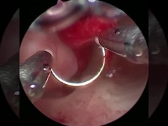 냉정 기술 플라즈마 수술 전극 비뇨기술 BPH 절차