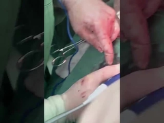 클리닉 간염학 론드 PLA408 오픈 수술용